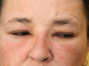 Close up image of swollen eyelids.