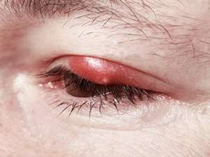 Image of a large red bump on an eyelid.