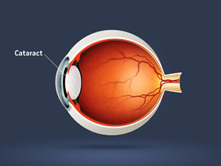 Cataract Image