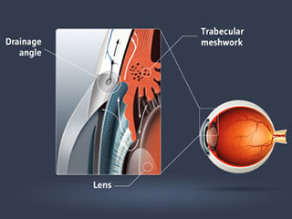 Glaucoma Image